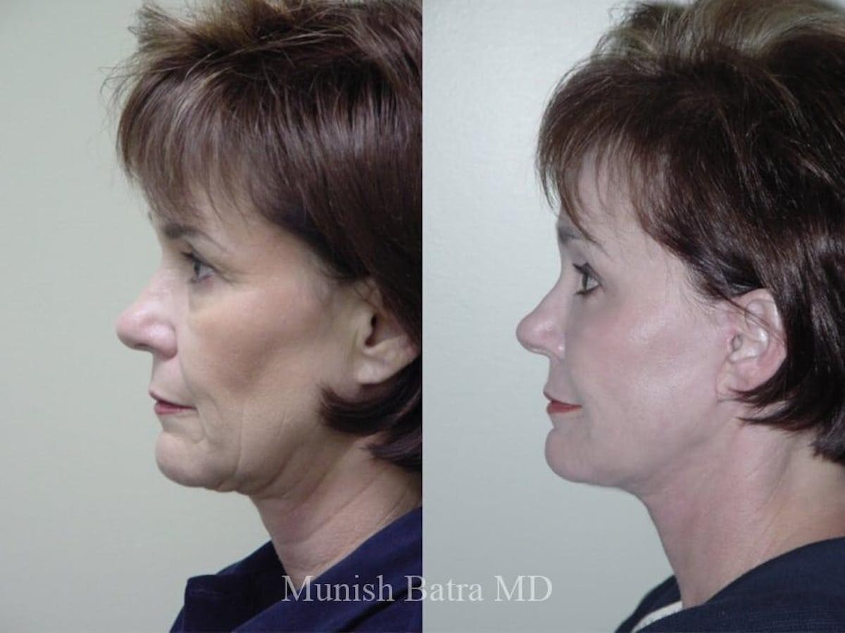 Facelift Before & After Gallery - Patient 205479 - Image 2