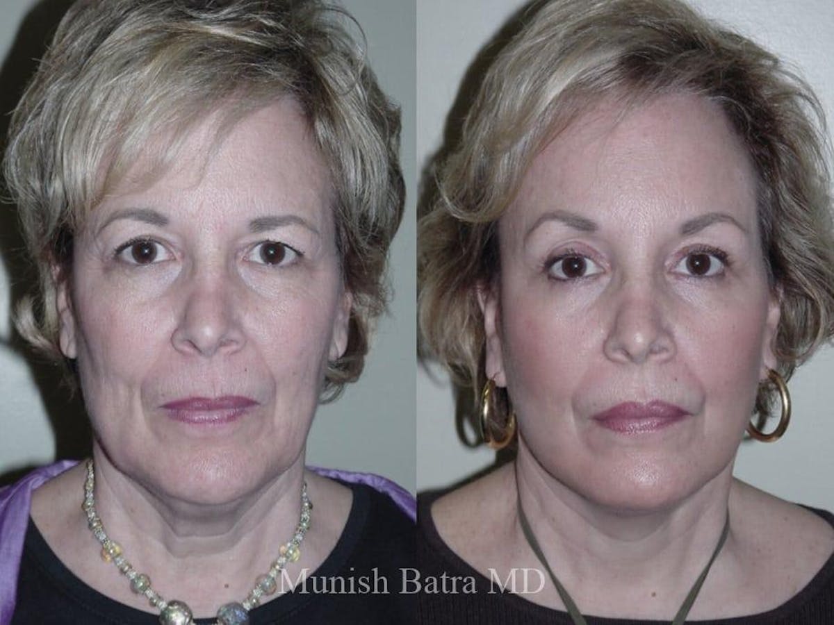Facelift Before & After Gallery - Patient 159437 - Image 1