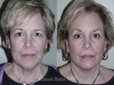 Facelift Before & After Gallery - Patient 159437 - Image 1