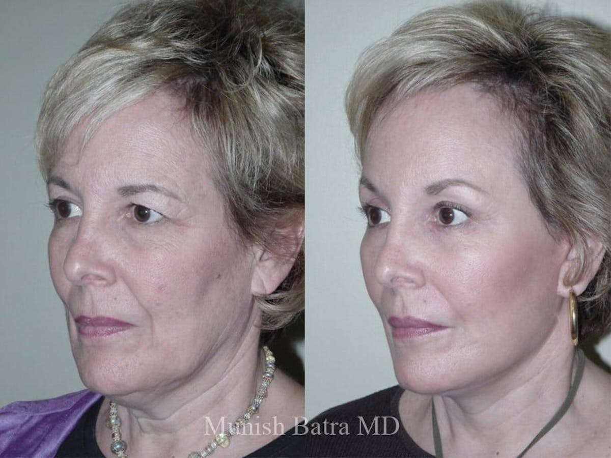 Facelift Before & After Gallery - Patient 159437 - Image 2