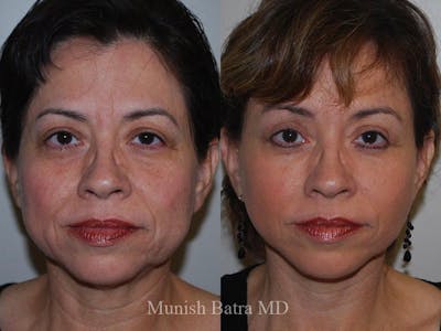 Facelift Before & After Gallery - Patient 519059 - Image 1