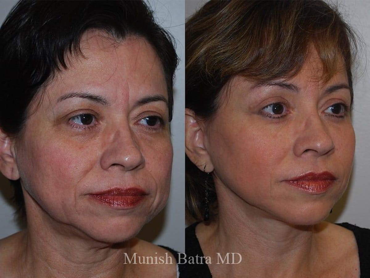 Facelift Before & After Gallery - Patient 519059 - Image 2