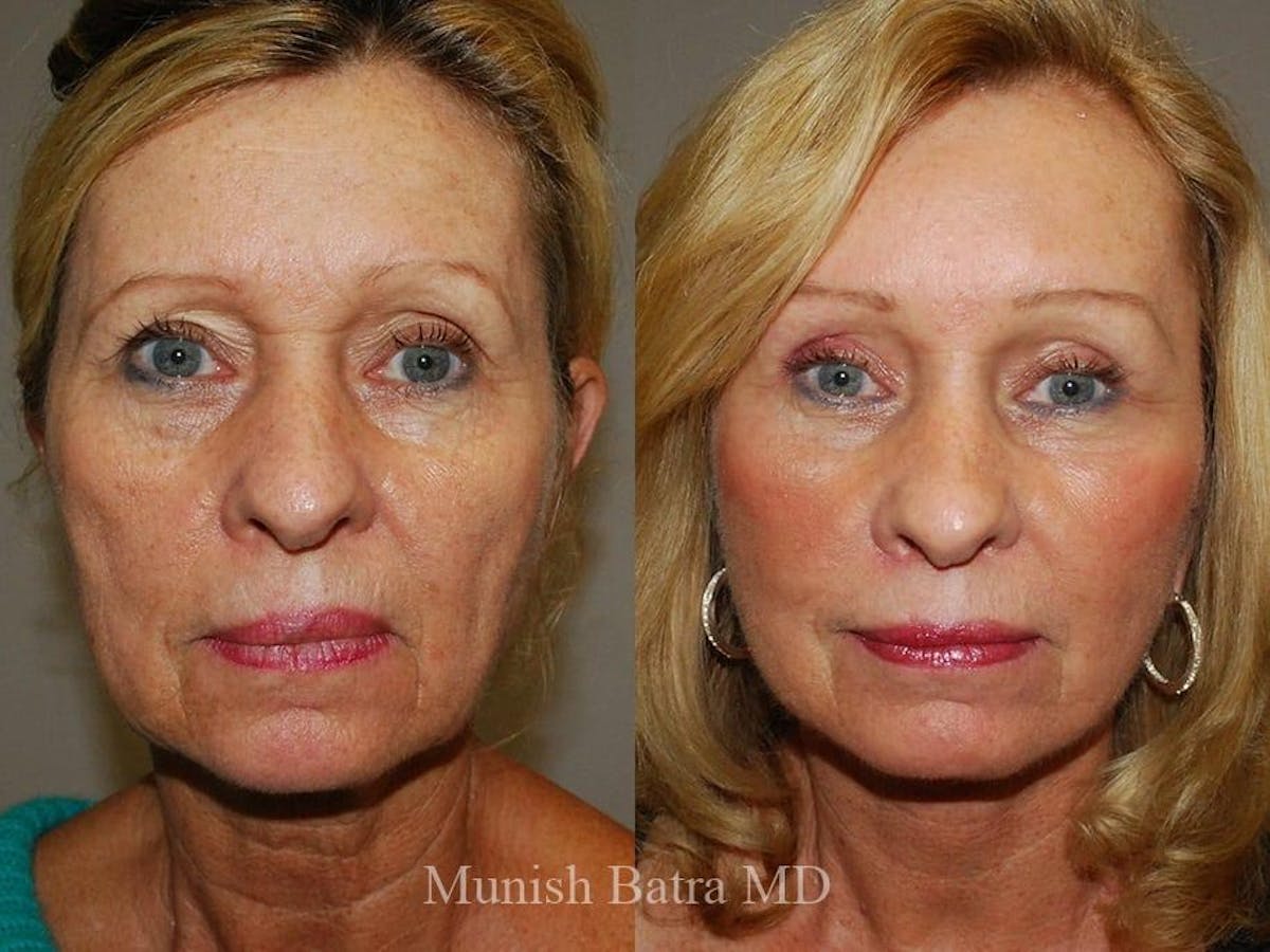 Facelift Before & After Gallery - Patient 375198 - Image 1