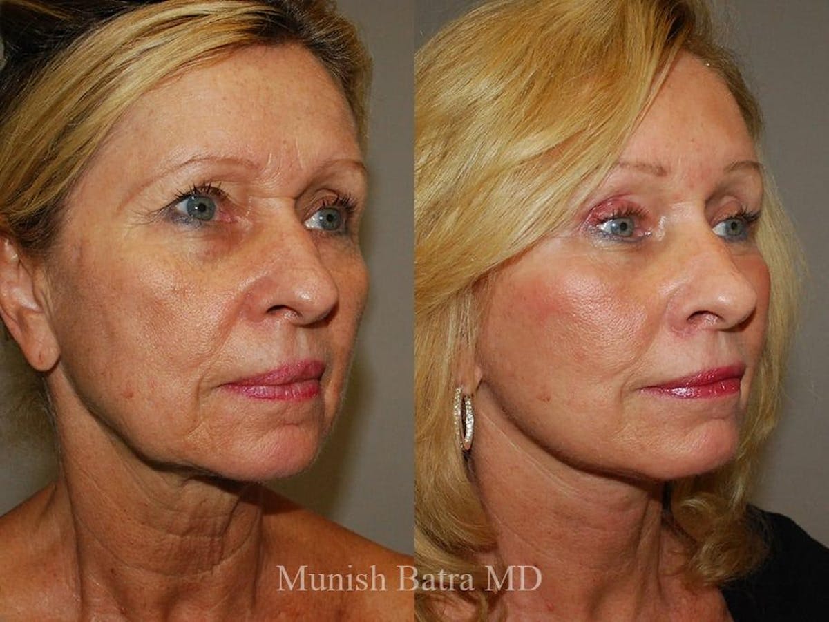 Facelift Before & After Gallery - Patient 375198 - Image 2