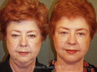 Facelift Before & After Gallery - Patient 325525 - Image 1