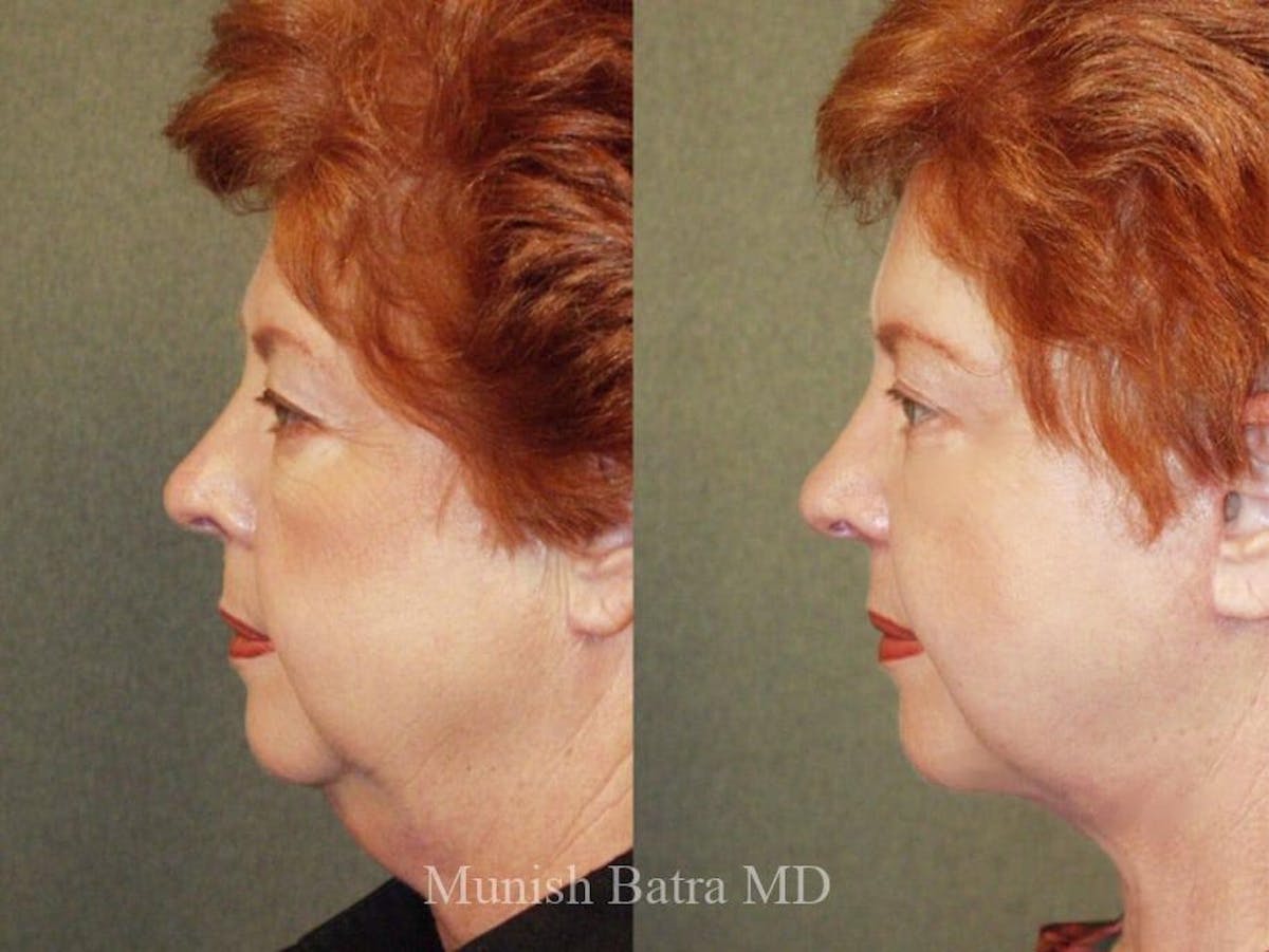 Facelift Before & After Gallery - Patient 325525 - Image 2