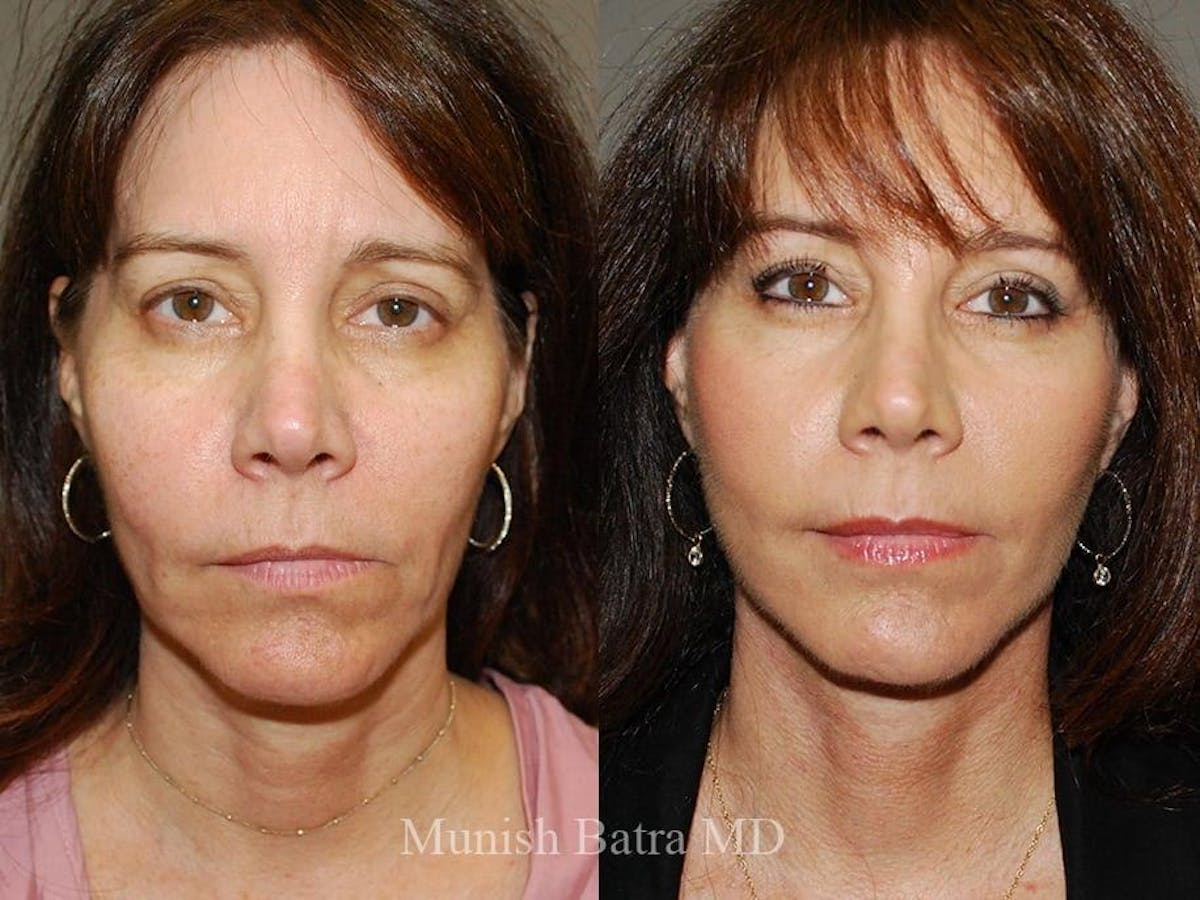 Facelift Before & After Gallery - Patient 163554 - Image 1