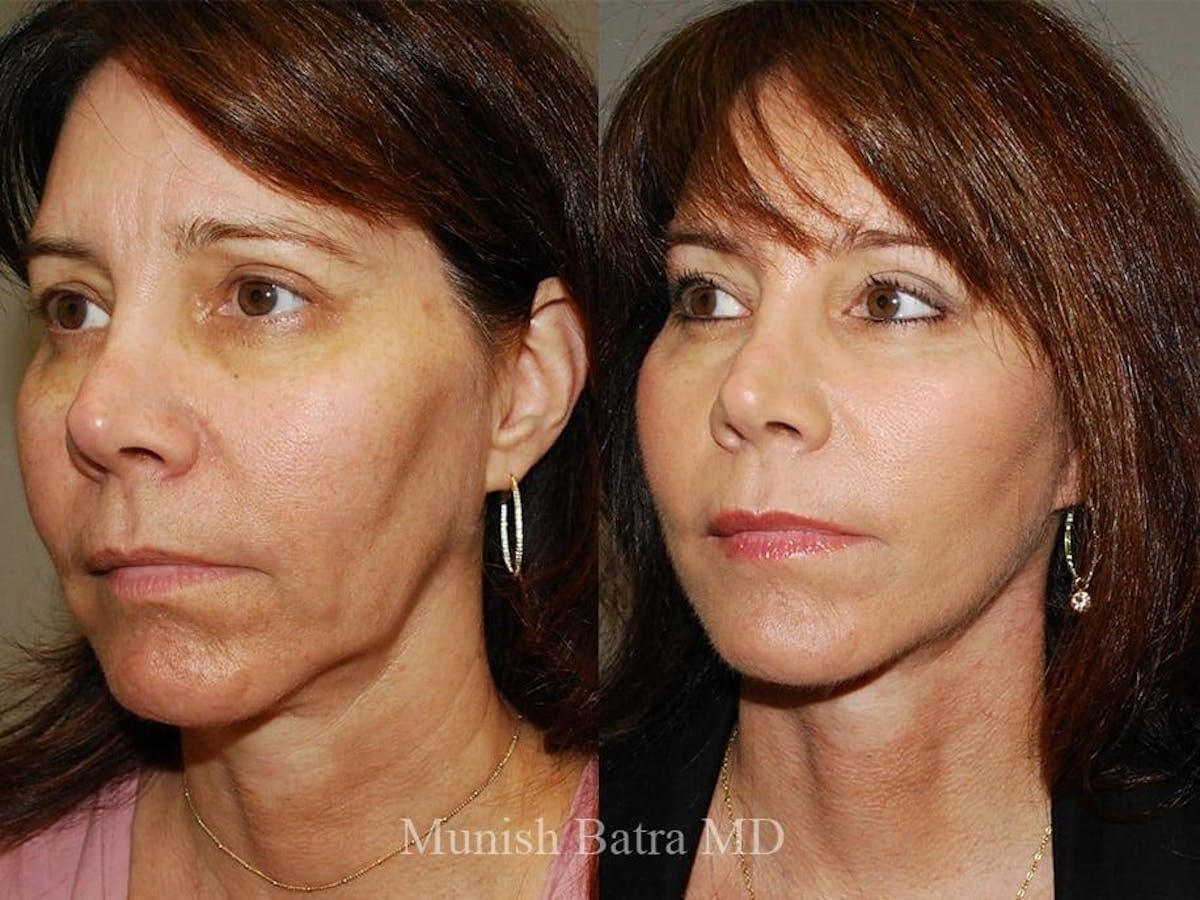 Facelift Before & After Gallery - Patient 163554 - Image 2
