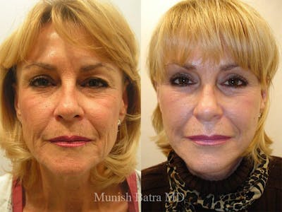 Facelift Before & After Gallery - Patient 112645 - Image 1