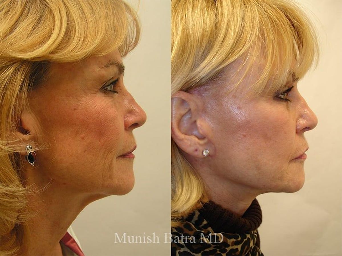 Facelift Before & After Gallery - Patient 112645 - Image 2