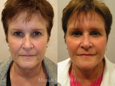 Facelift Before & After Gallery - Patient 126822 - Image 1