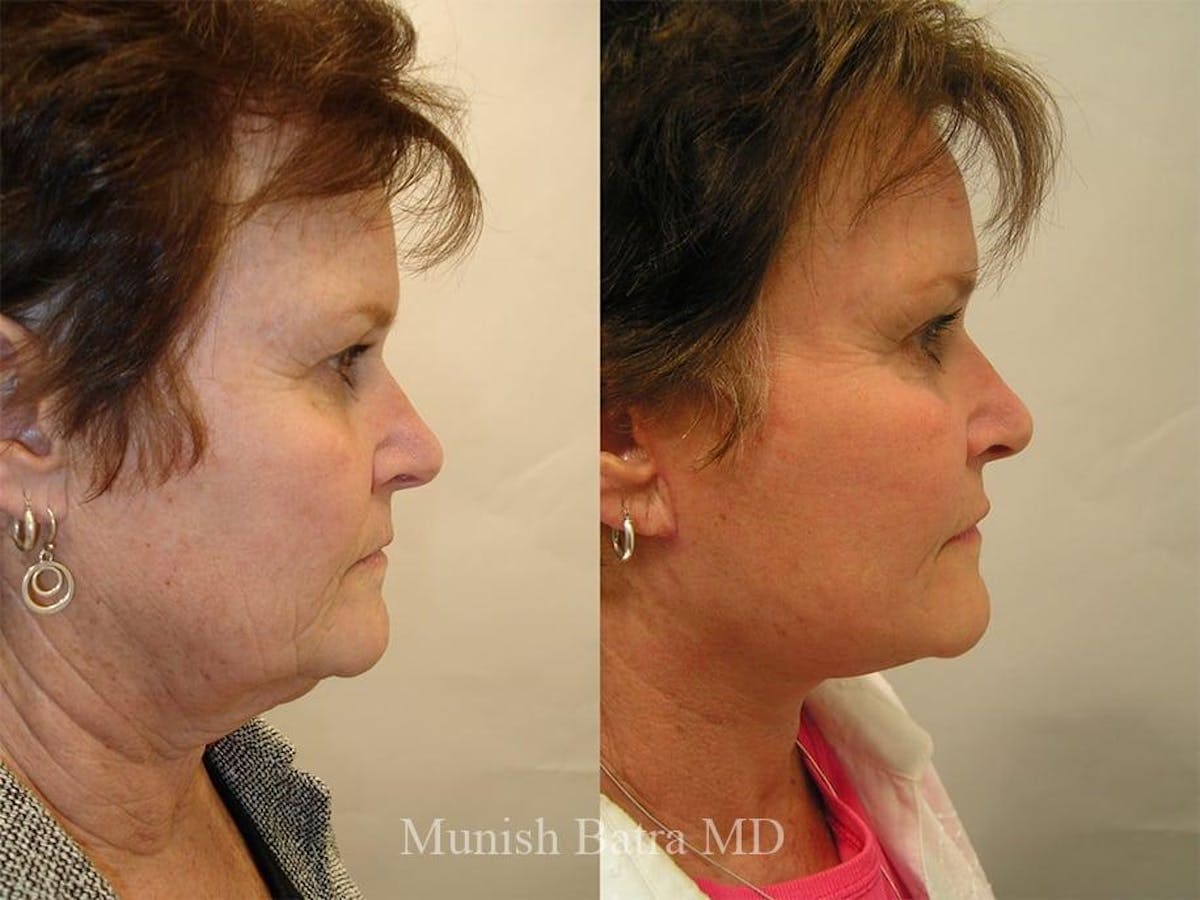 Facelift Before & After Gallery - Patient 126822 - Image 2