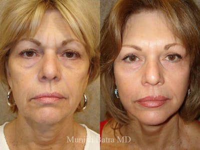 Facelift Before & After Gallery - Patient 373544 - Image 1