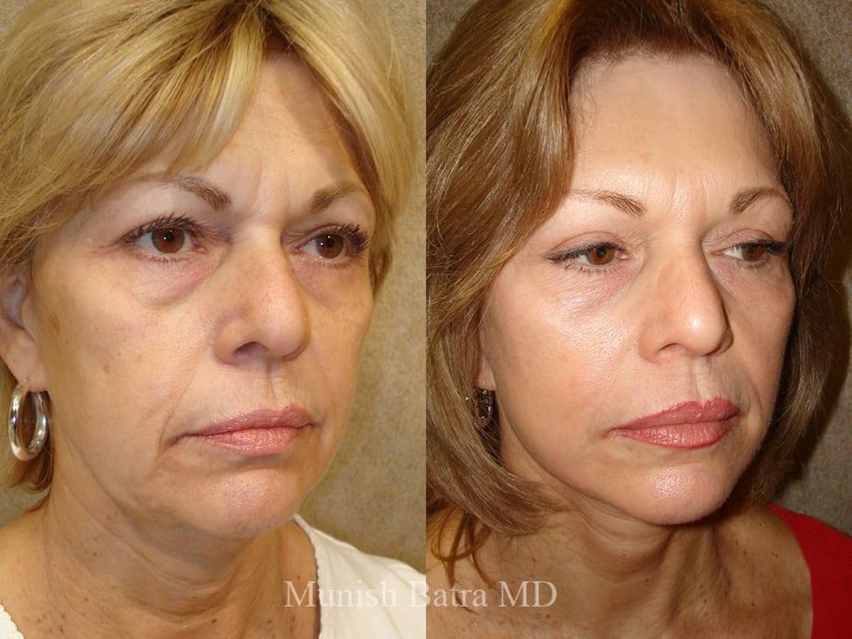 Facelift Before & After Gallery - Patient 373544 - Image 2