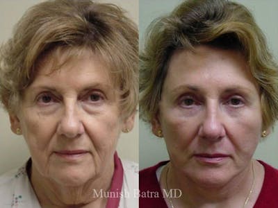 Facelift Before & After Gallery - Patient 420138 - Image 1