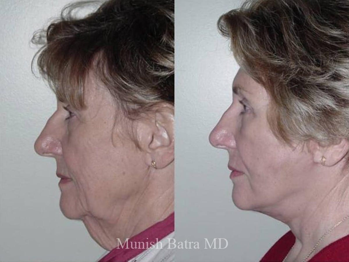 Facelift Before & After Gallery - Patient 420138 - Image 2