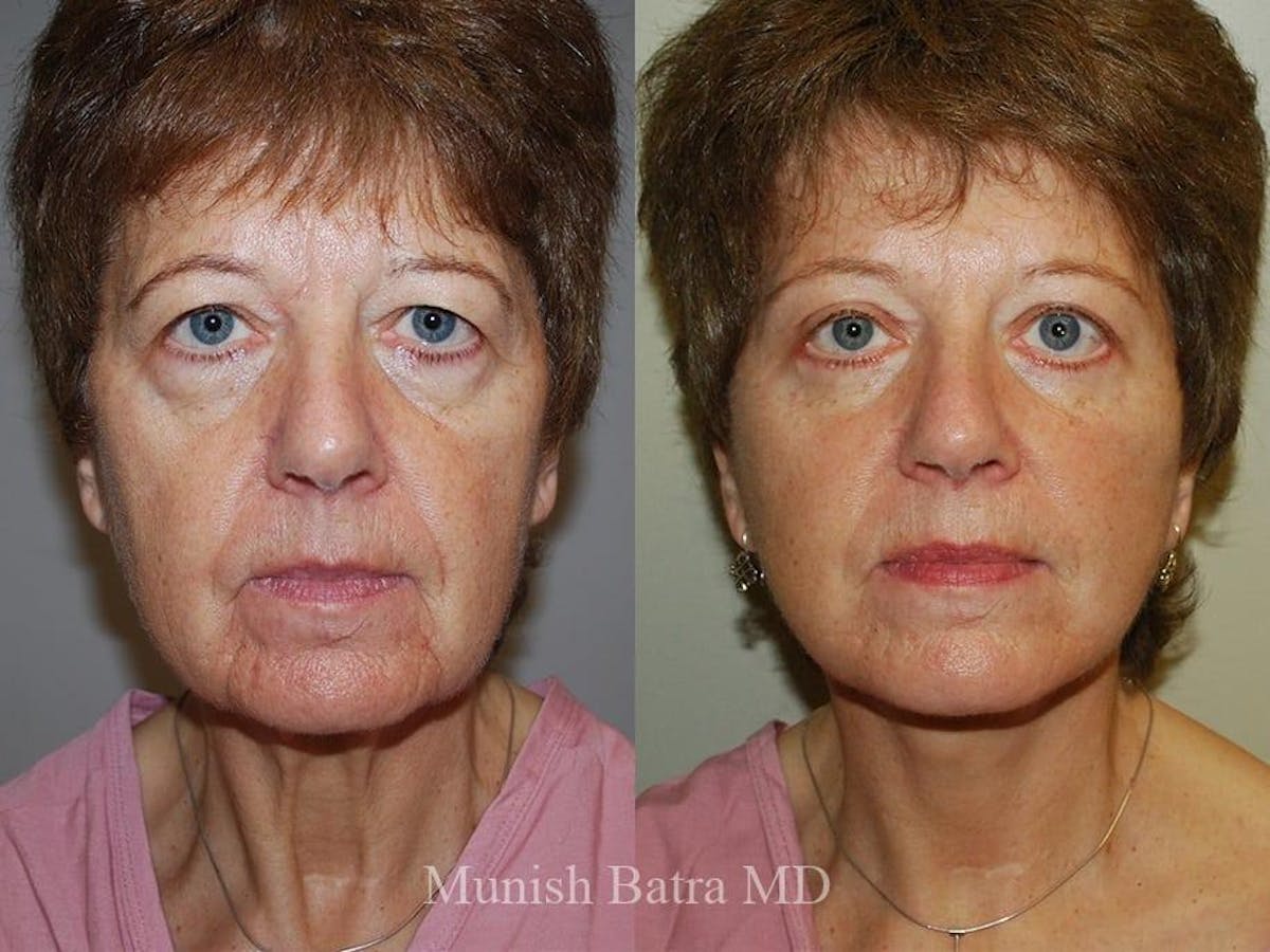Facelift Before & After Gallery - Patient 880953 - Image 1