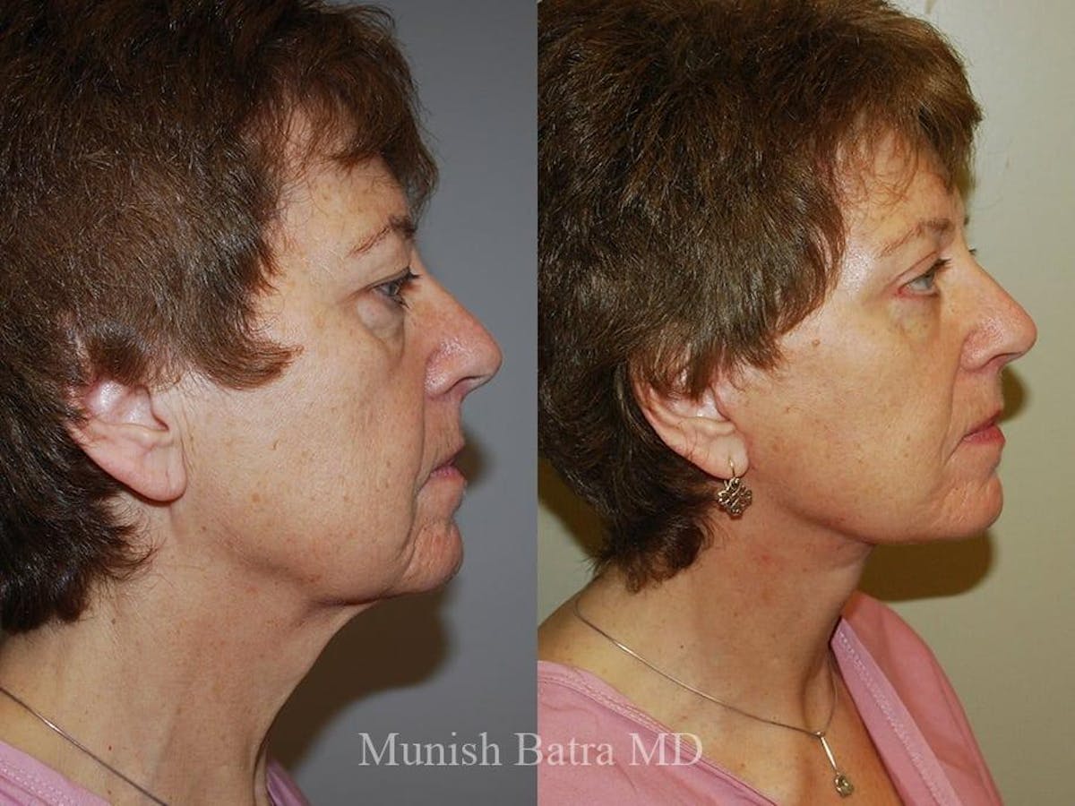 Facelift Before & After Gallery - Patient 880953 - Image 2