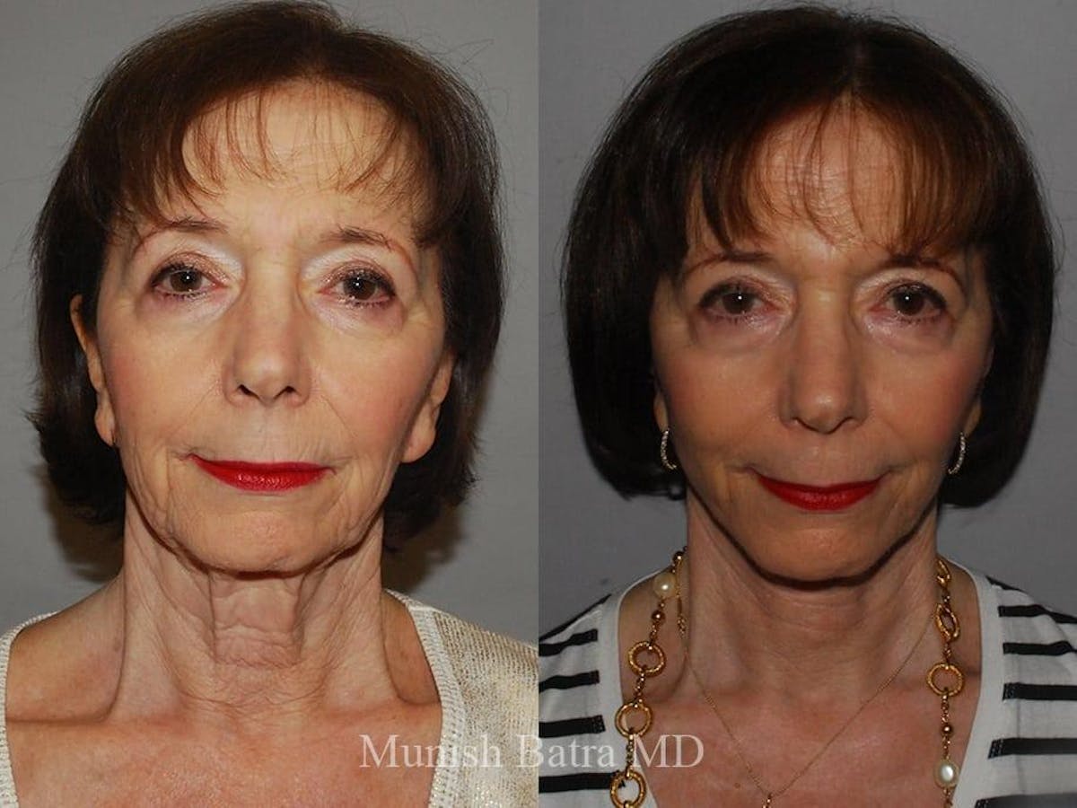 Facelift Before & After Gallery - Patient 155926 - Image 1