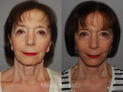 Facelift Before & After Gallery - Patient 155926 - Image 1