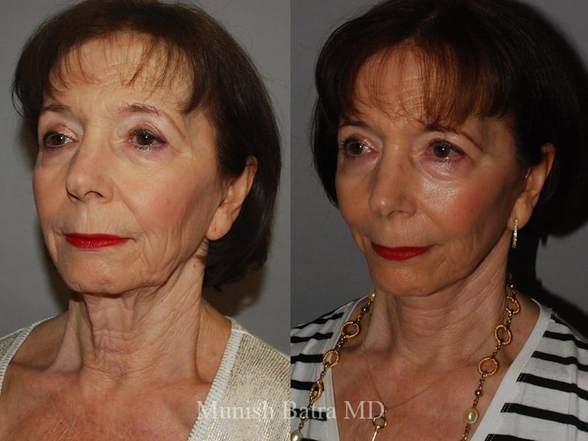 Facelift Before & After Gallery - Patient 155926 - Image 2