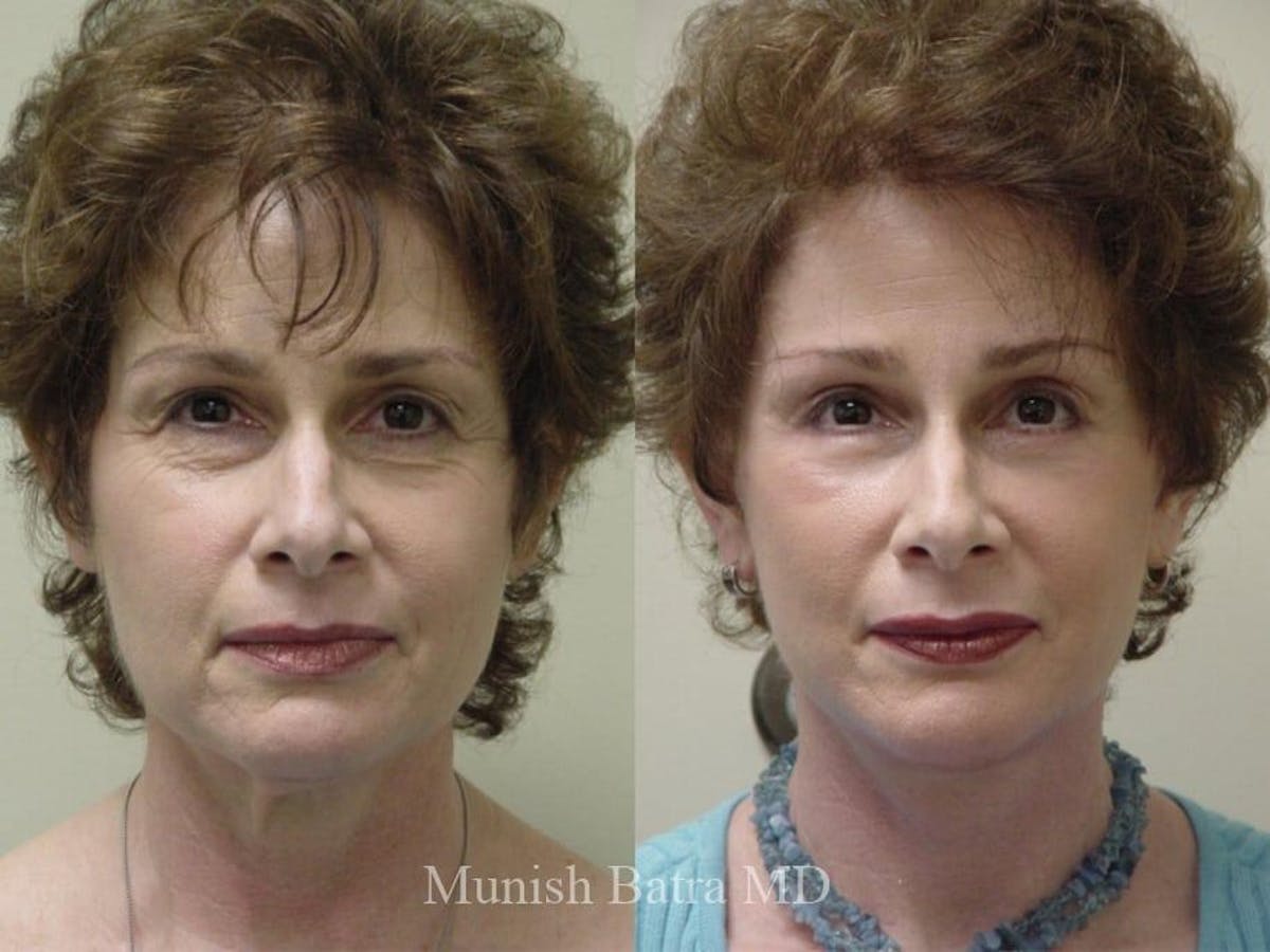 Facelift Before & After Gallery - Patient 841833 - Image 1