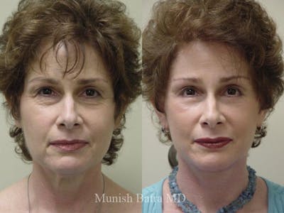 Facelift Before & After Gallery - Patient 841833 - Image 1