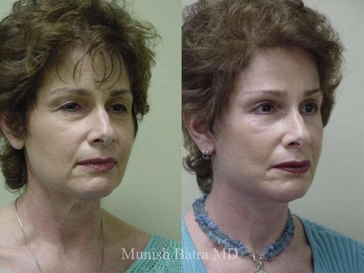 Facelift Before & After Gallery - Patient 841833 - Image 2