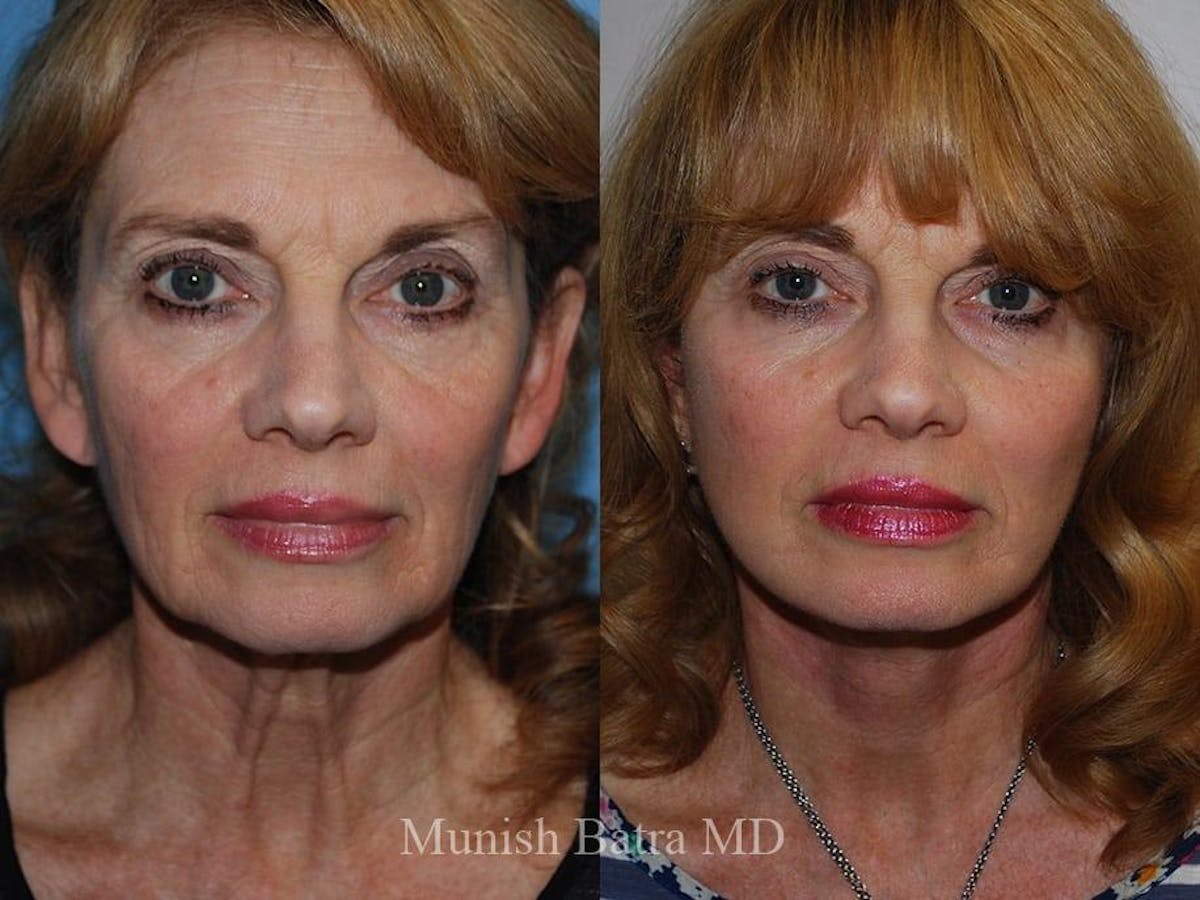 Facelift Before & After Gallery - Patient 144281 - Image 1