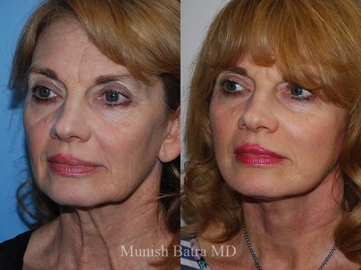 Facelift Before & After Gallery - Patient 144281 - Image 2