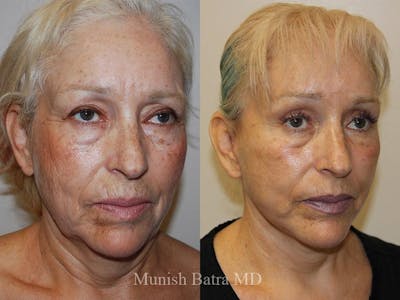 Facelift Before & After Gallery - Patient 244070 - Image 1