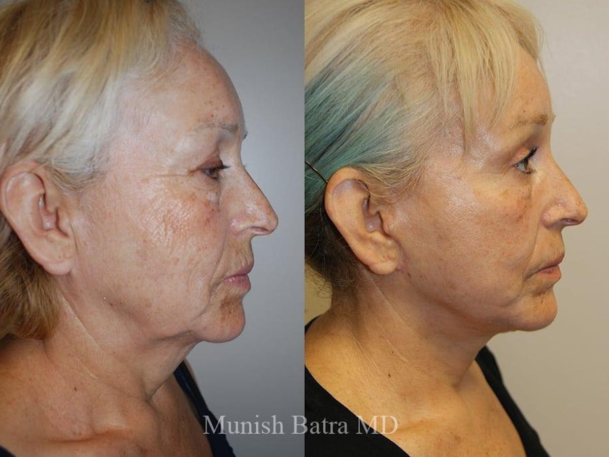 Facelift Before & After Gallery - Patient 244070 - Image 2