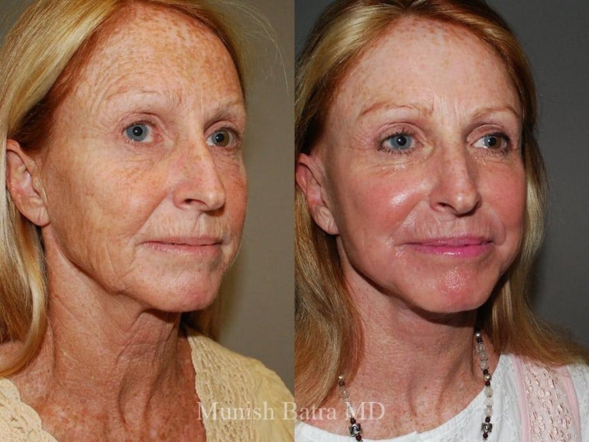 Facelift Before & After Gallery - Patient 215333 - Image 1