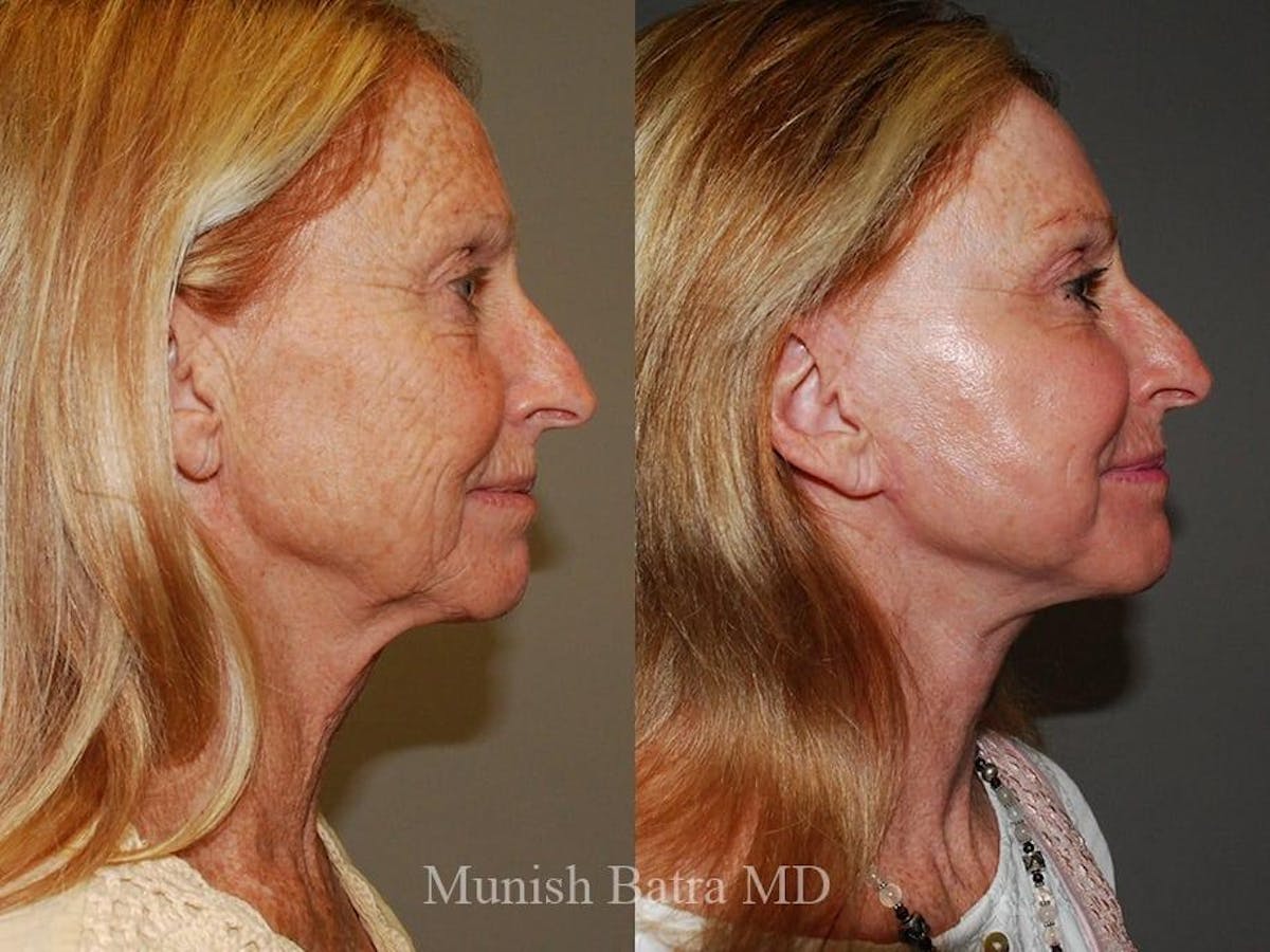 Facelift Before & After Gallery - Patient 215333 - Image 2
