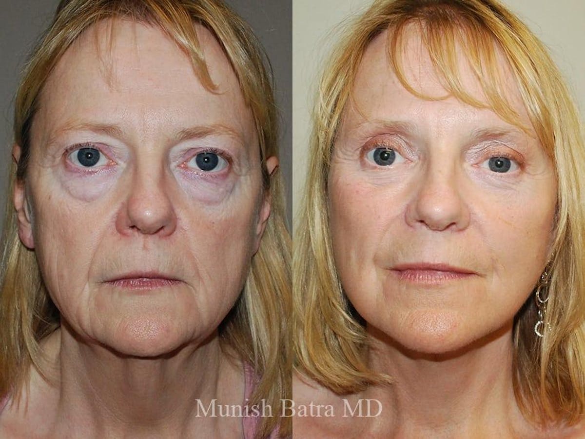 Facelift Before & After Gallery - Patient 207841 - Image 1