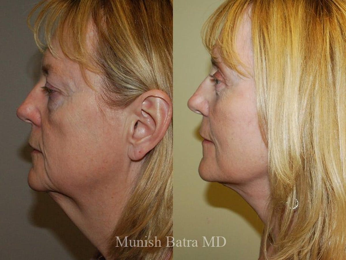 Facelift Before & After Gallery - Patient 207841 - Image 2