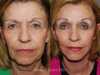Facelift Before & After Gallery - Patient 269093 - Image 1