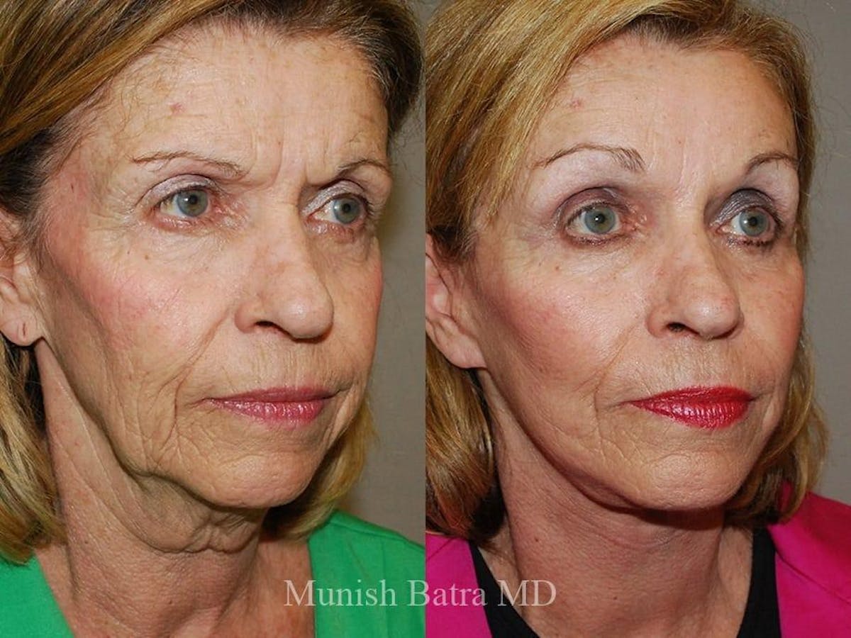 Facelift Before & After Gallery - Patient 269093 - Image 2