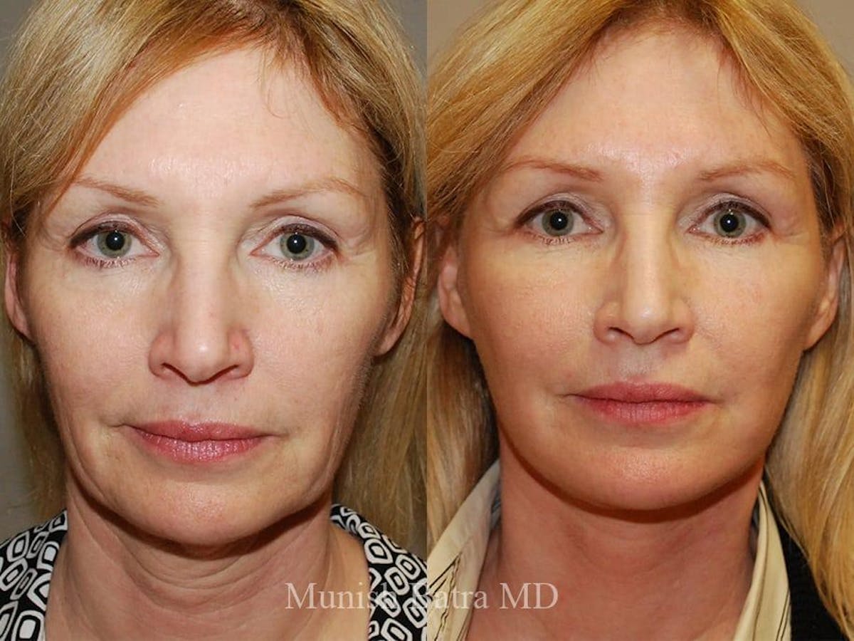 Facelift Before & After Gallery - Patient 635127 - Image 1