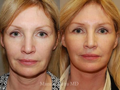 Facelift Before & After Gallery - Patient 635127 - Image 1