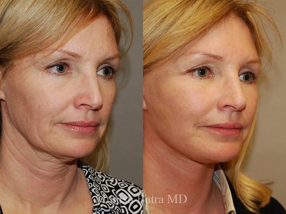 Facelift Before & After Gallery - Patient 635127 - Image 2