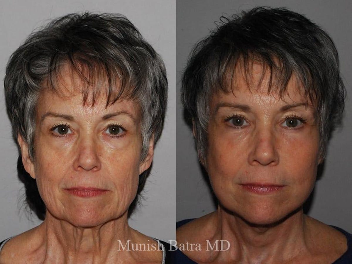 Facelift Before & After Gallery - Patient 274864 - Image 1