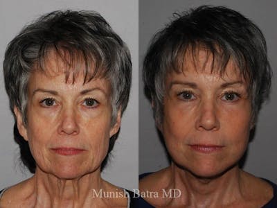 Facelift Before & After Gallery - Patient 274864 - Image 1