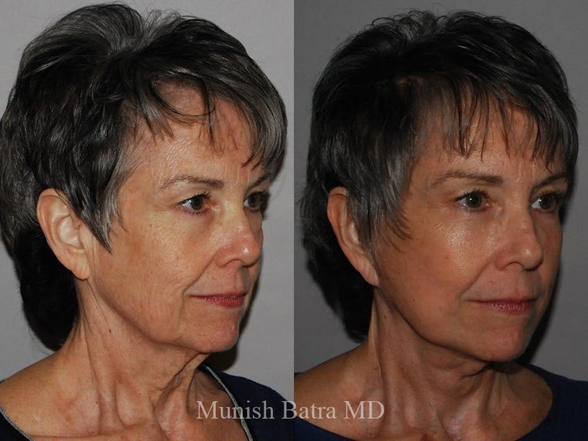 Facelift Before & After Gallery - Patient 274864 - Image 2