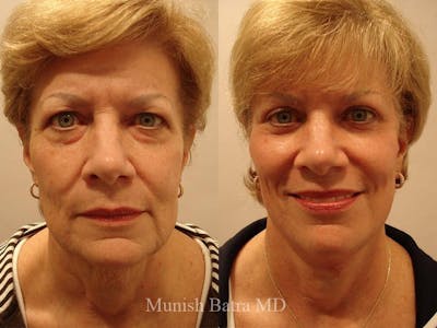 Facelift Before & After Gallery - Patient 168734 - Image 1