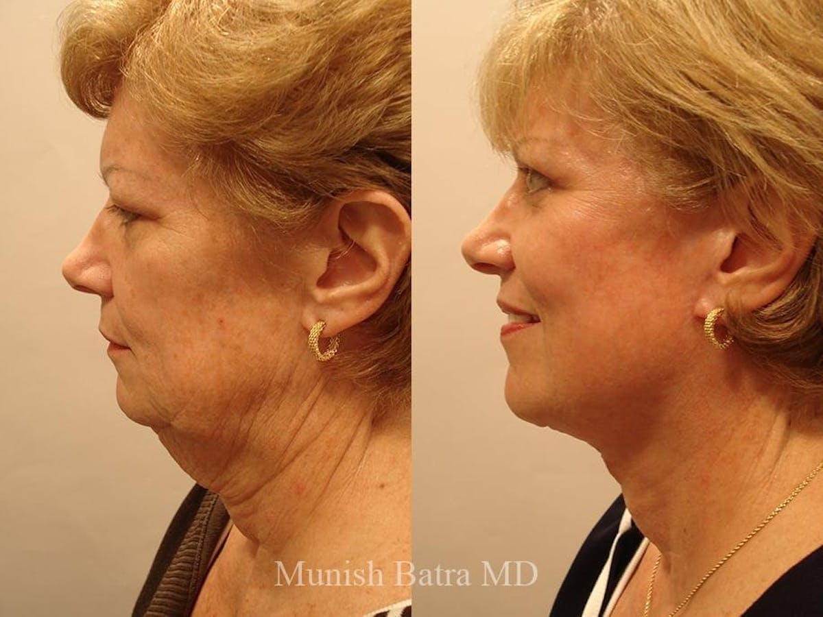Facelift Before & After Gallery - Patient 168734 - Image 2