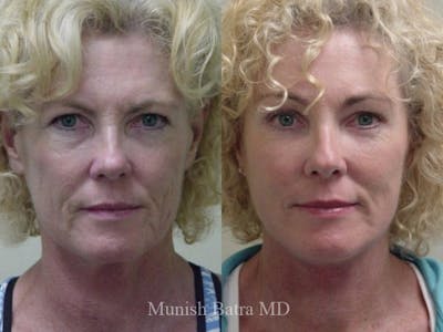 Facelift Before & After Gallery - Patient 141032 - Image 1