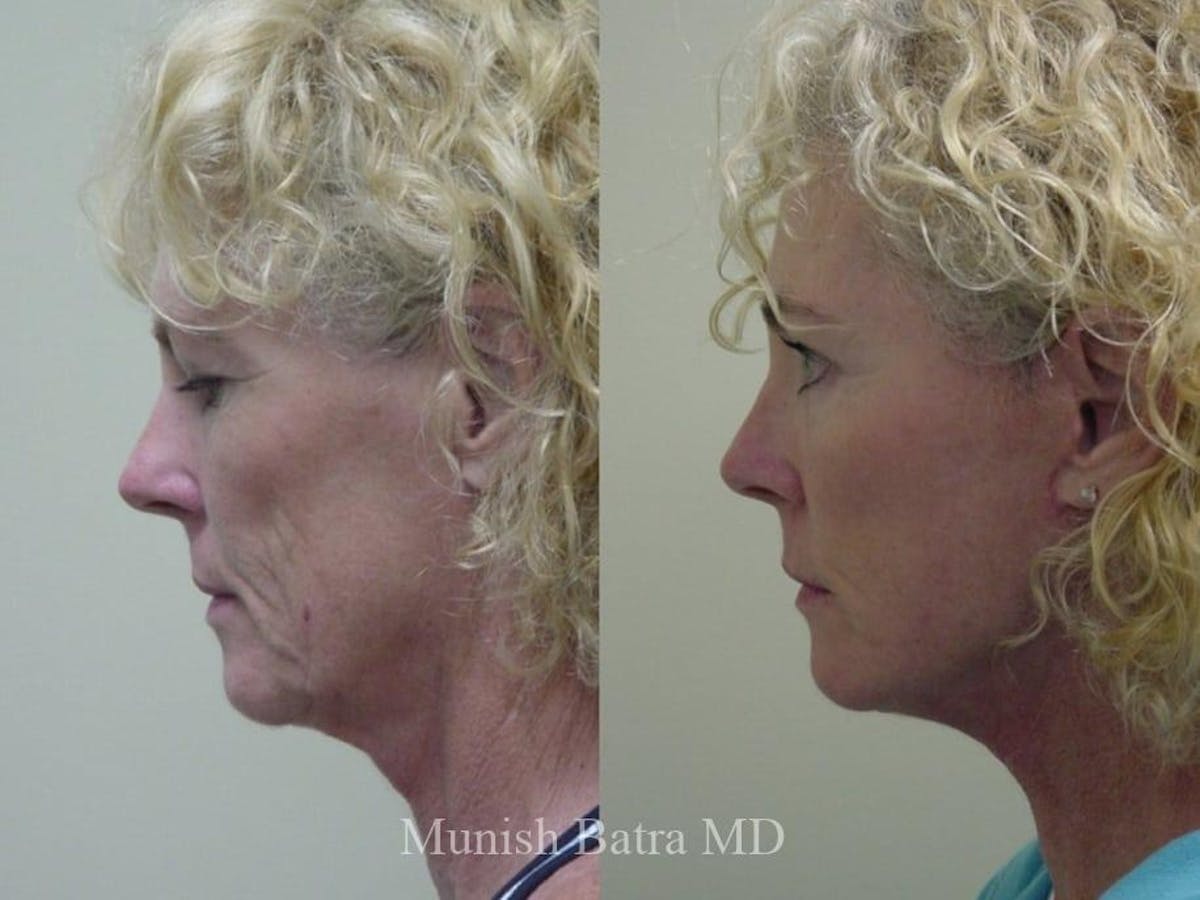 Facelift Before & After Gallery - Patient 141032 - Image 2