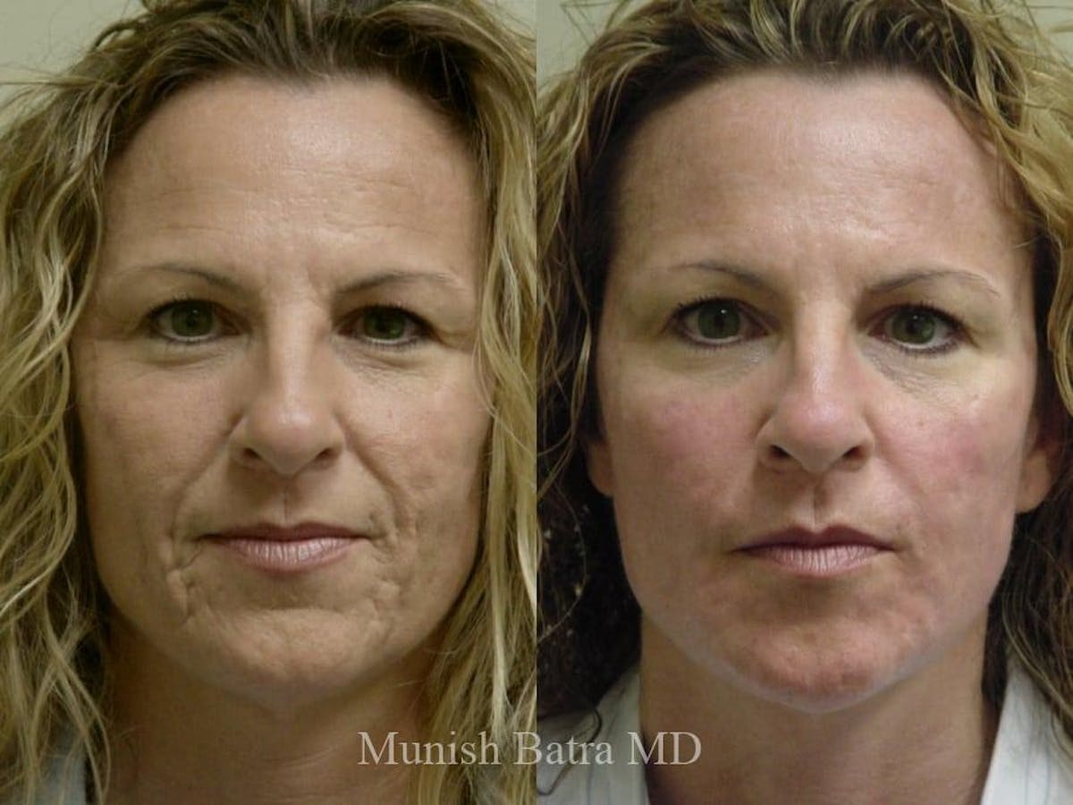 Facelift Before & After Gallery - Patient 211631 - Image 1