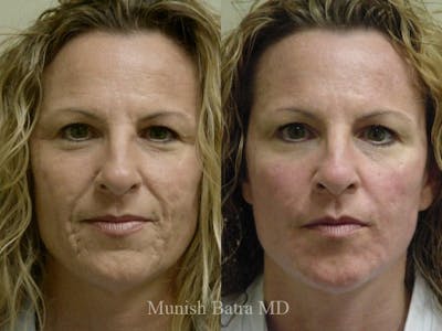 Facelift Before & After Gallery - Patient 211631 - Image 1